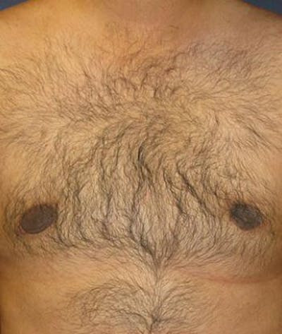 Male Subcutaneous Mastectomy (Gynecomastia) Before & After Gallery - Patient 186025 - Image 2