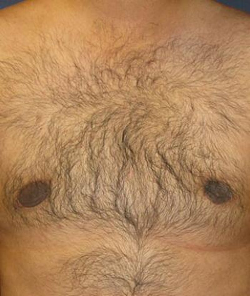 Male Subcutaneous Mastectomy (Gynecomastia) Before & After Gallery - Patient 186025 - Image 2