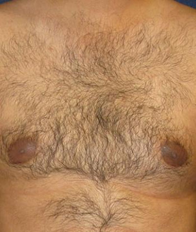 Male Subcutaneous Mastectomy (Gynecomastia) Before & After Gallery - Patient 186025 - Image 1