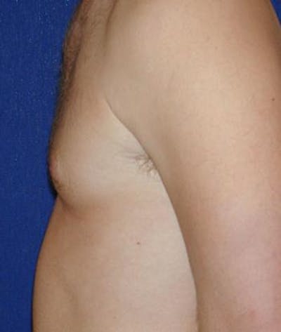 Male Subcutaneous Mastectomy (Gynecomastia) Before & After Gallery - Patient 261188 - Image 2