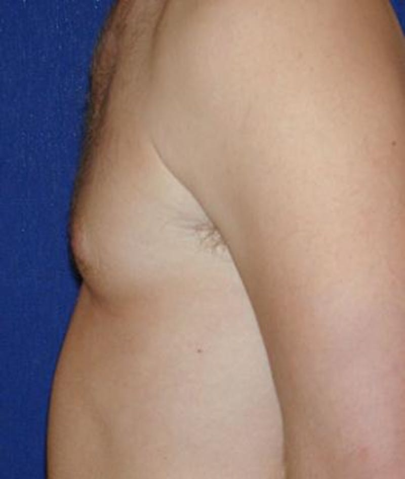 Male Subcutaneous Mastectomy (Gynecomastia) Before & After Gallery - Patient 261188 - Image 2
