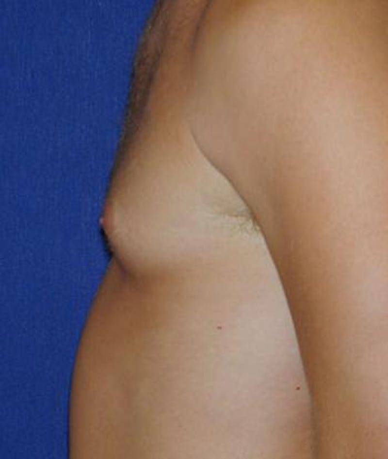 Male Subcutaneous Mastectomy (Gynecomastia) Before & After Gallery - Patient 261188 - Image 1