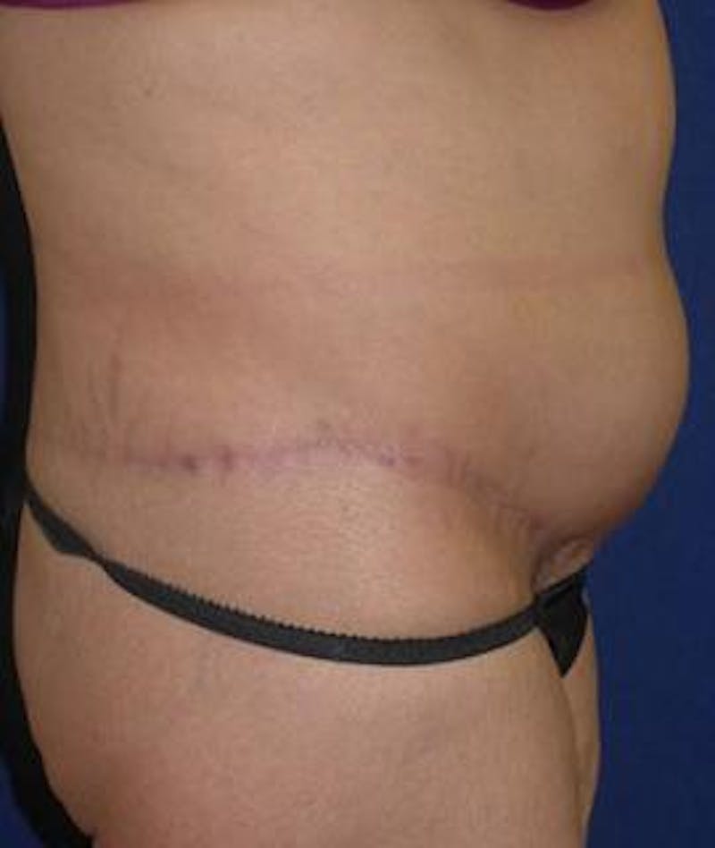 Tummy Tuck (Abdominoplasty) Before & After Gallery - Patient 144114 - Image 4
