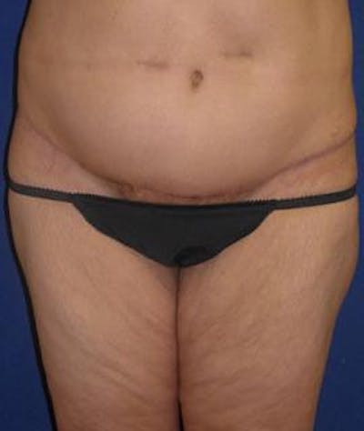 Tummy Tuck (Abdominoplasty) Before & After Gallery - Patient 144114 - Image 2