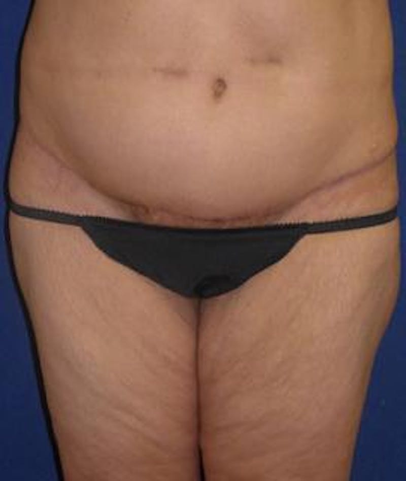 Tummy Tuck (Abdominoplasty) Before & After Gallery - Patient 144114 - Image 2
