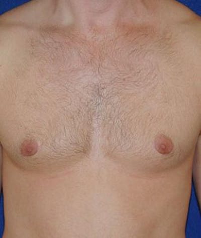Male Subcutaneous Mastectomy (Gynecomastia) Before & After Gallery - Patient 244495 - Image 2