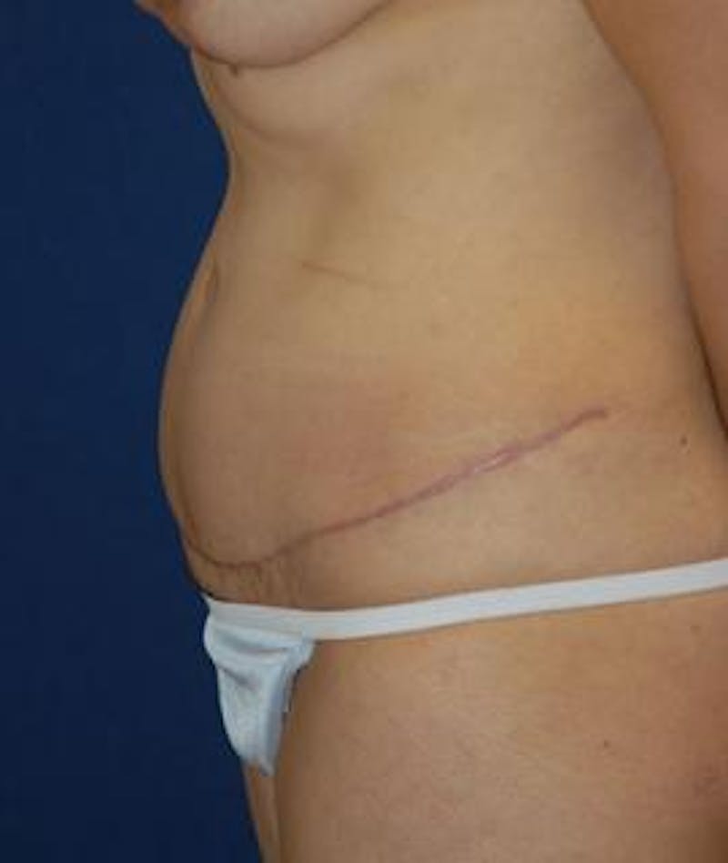 Tummy Tuck (Abdominoplasty) Before & After Gallery - Patient 138195 - Image 4