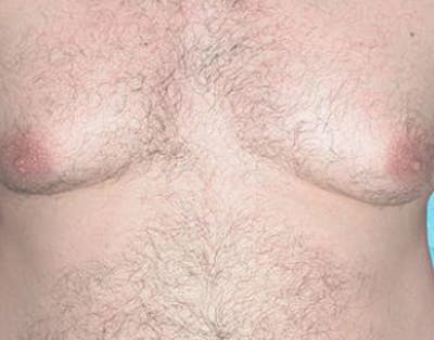 Male Subcutaneous Mastectomy (Gynecomastia) Before & After Gallery - Patient 223472 - Image 1