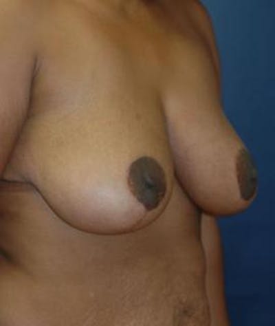 Breast Reduction Before & After Gallery - Patient 858730 - Image 2