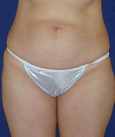 Tummy Tuck (Abdominoplasty) Before & After Gallery - Patient 138195 - Image 1