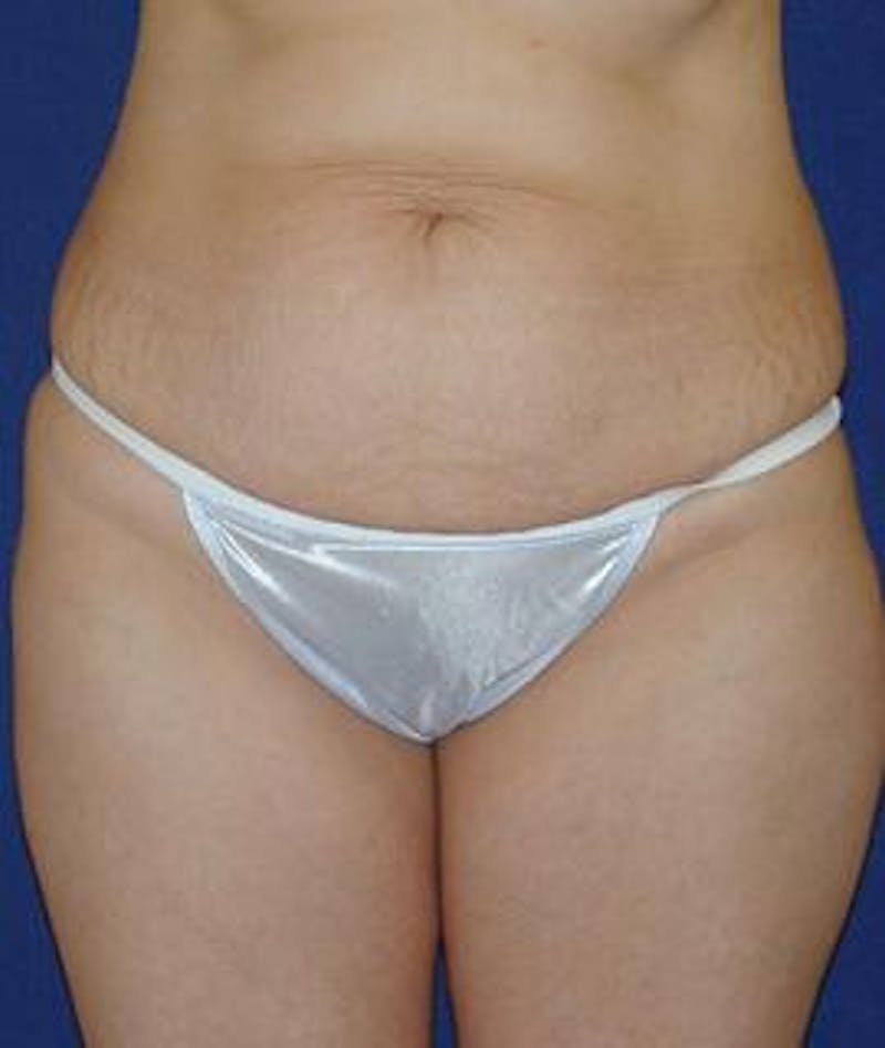 Tummy Tuck (Abdominoplasty) Before & After Gallery - Patient 138195 - Image 1