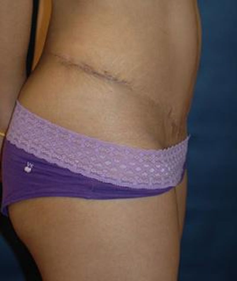 Tummy Tuck (Abdominoplasty) Before & After Gallery - Patient 372388 - Image 4