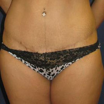 Tummy Tuck (Abdominoplasty) Before & After Gallery - Patient 372388 - Image 2