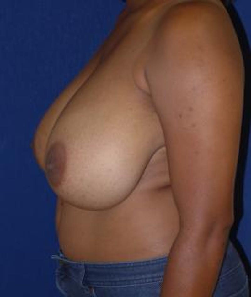 Breast Reduction Before & After Gallery - Patient 321180 - Image 5