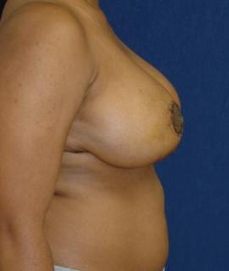 Breast Reduction Before & After Gallery - Patient 321180 - Image 4
