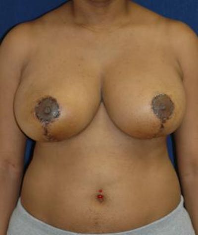 Breast Reduction Before & After Gallery - Patient 321180 - Image 2