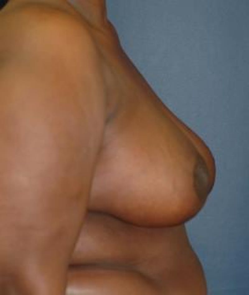 Breast Reduction Before & After Gallery - Patient 403154 - Image 4