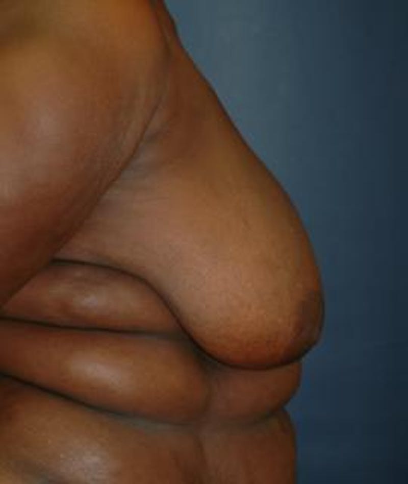 Breast Reduction Before & After Gallery - Patient 403154 - Image 3