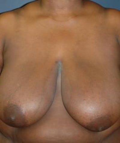 Breast Reduction Before & After Gallery - Patient 403154 - Image 1