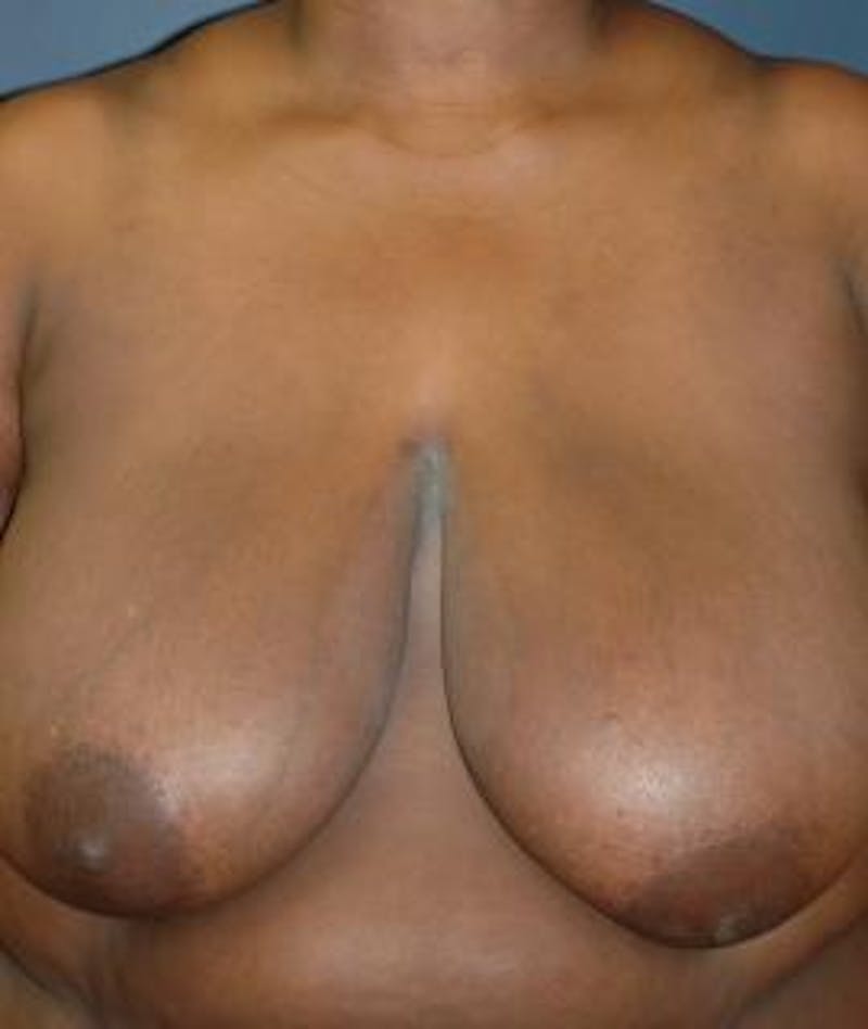 Breast Reduction Before & After Gallery - Patient 403154 - Image 1
