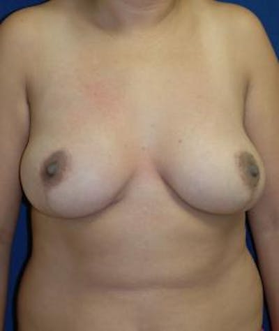 Breast Reduction Before & After Gallery - Patient 898557 - Image 2