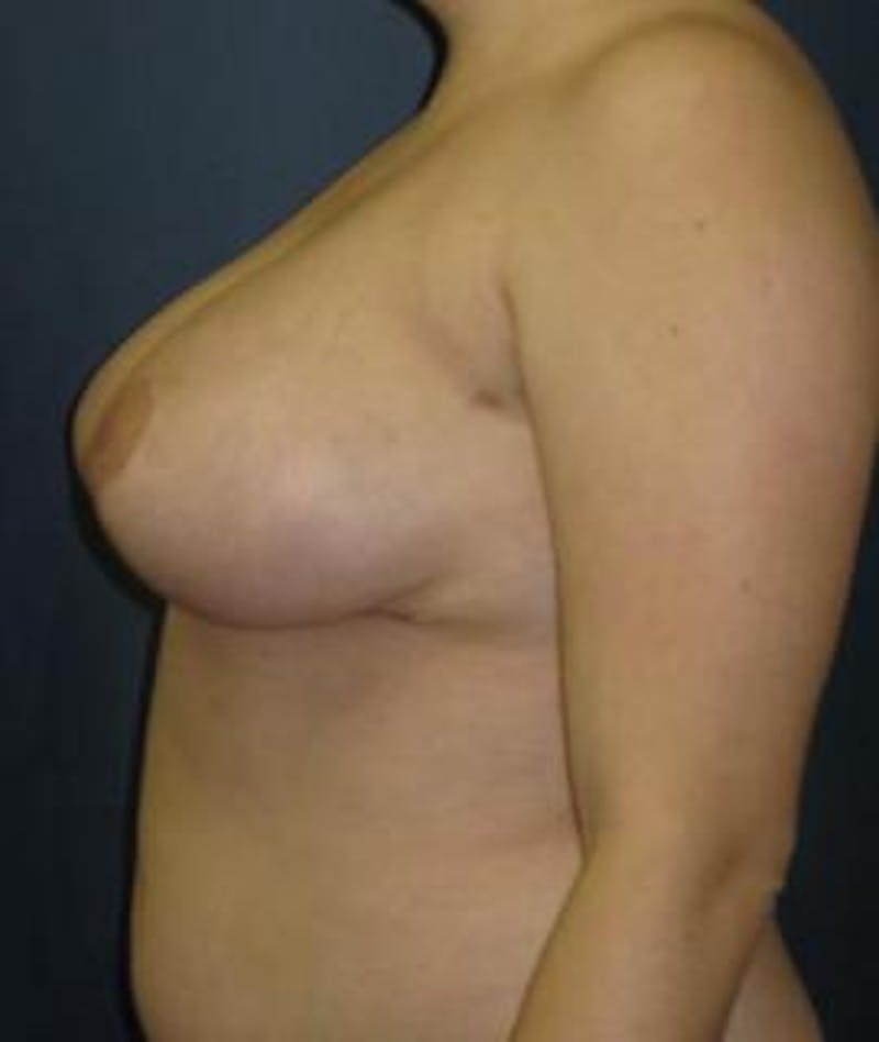 Breast Reduction Before & After Gallery - Patient 157648 - Image 4