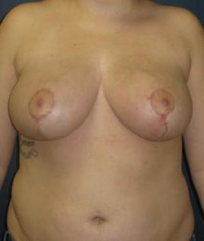 Breast Reduction Before & After Gallery - Patient 157648 - Image 2