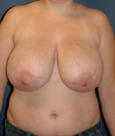 Breast Reduction Before & After Gallery - Patient 157648 - Image 1