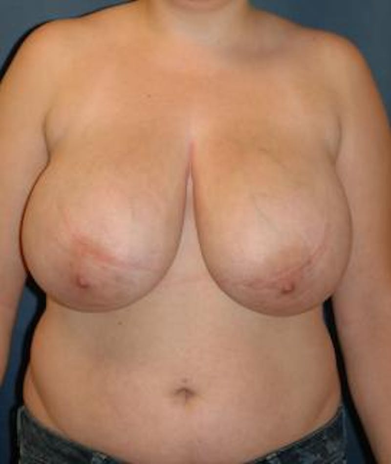 Breast Reduction Before & After Gallery - Patient 157648 - Image 1