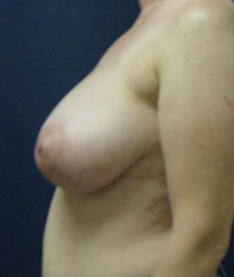 Breast Reduction Before & After Gallery - Patient 238354 - Image 3