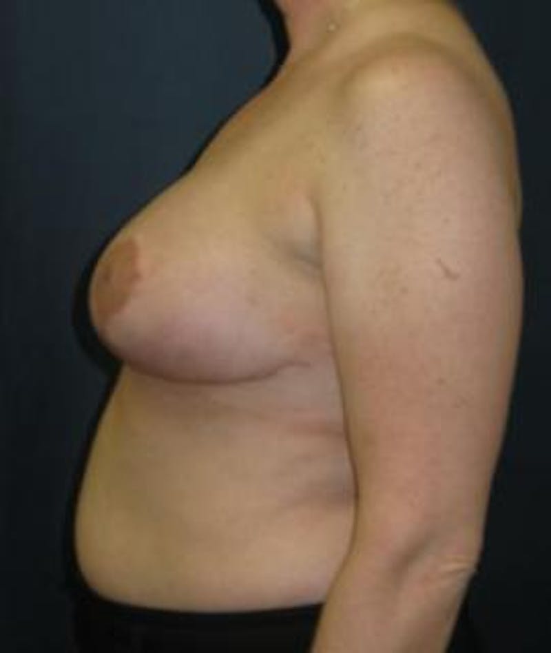 Breast Reduction Before & After Gallery - Patient 238354 - Image 4
