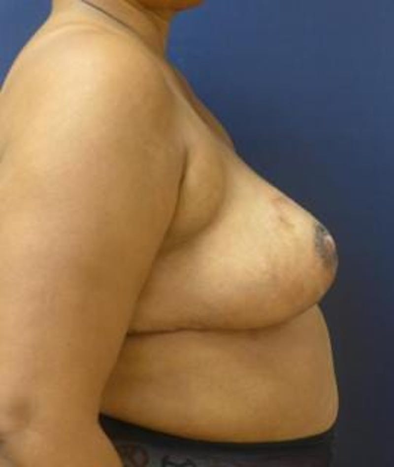 Breast Reduction Before & After Gallery - Patient 177154 - Image 4