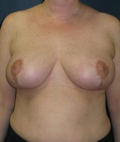 Breast Reduction Before & After Gallery - Patient 238354 - Image 2