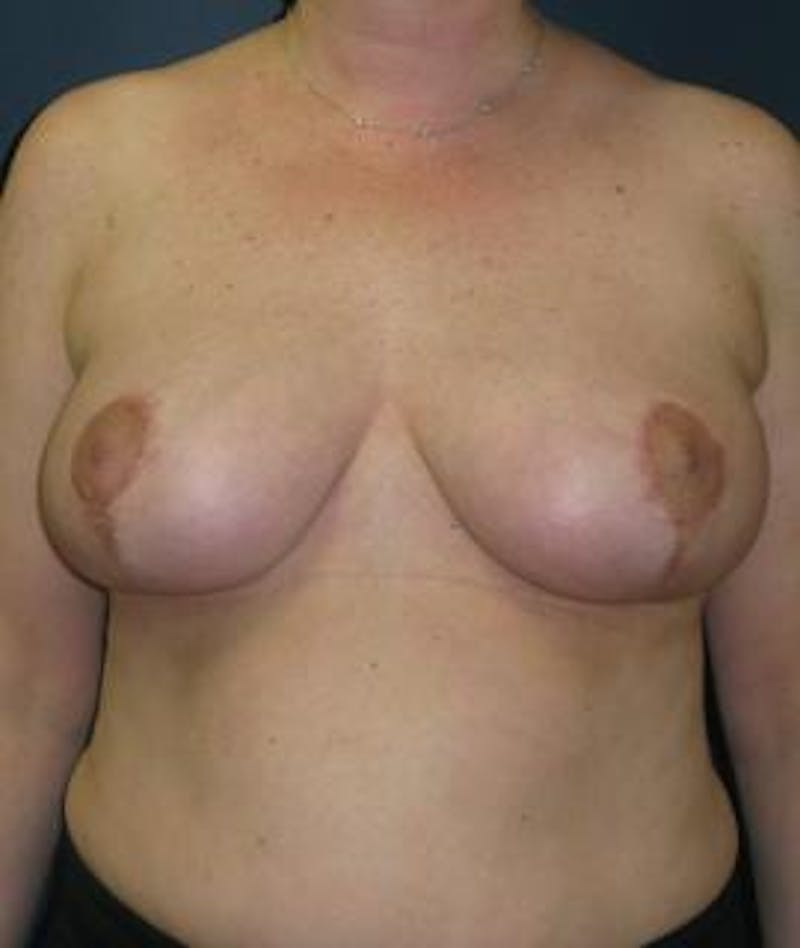 Breast Reduction Before & After Gallery - Patient 238354 - Image 2