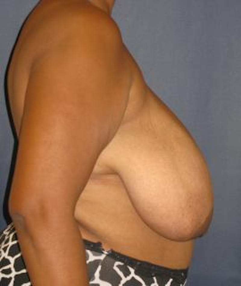 Breast Reduction Before & After Gallery - Patient 177154 - Image 3