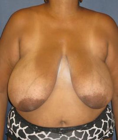 Breast Reduction Before & After Gallery - Patient 177154 - Image 1