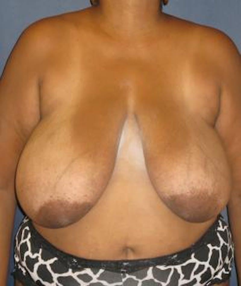 Breast Reduction Before & After Gallery - Patient 177154 - Image 1