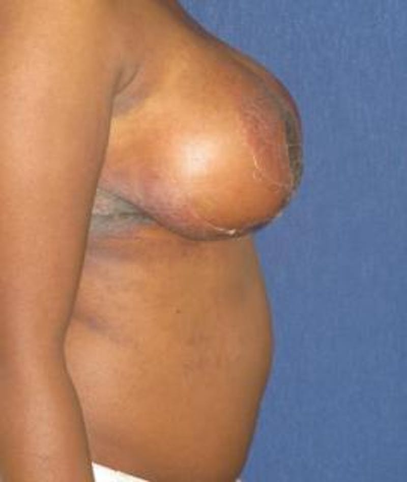 Breast Reduction Before & After Gallery - Patient 339980 - Image 4