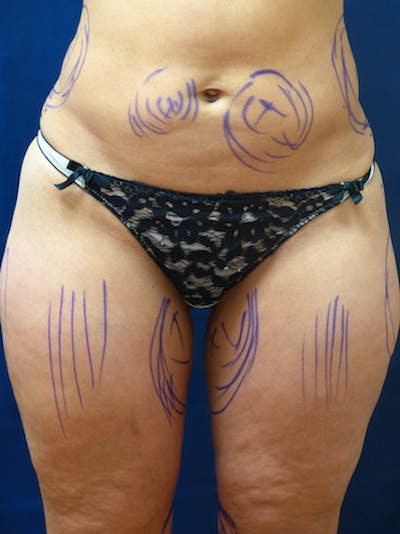 Liposuction Before & After Gallery - Patient 156776 - Image 1