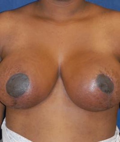 Breast Reduction Before & After Gallery - Patient 339980 - Image 2