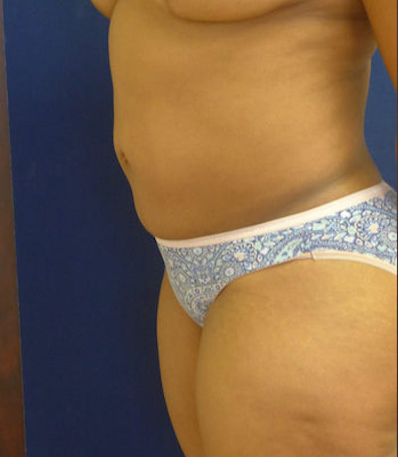 Liposuction Before & After Gallery - Patient 108913 - Image 4