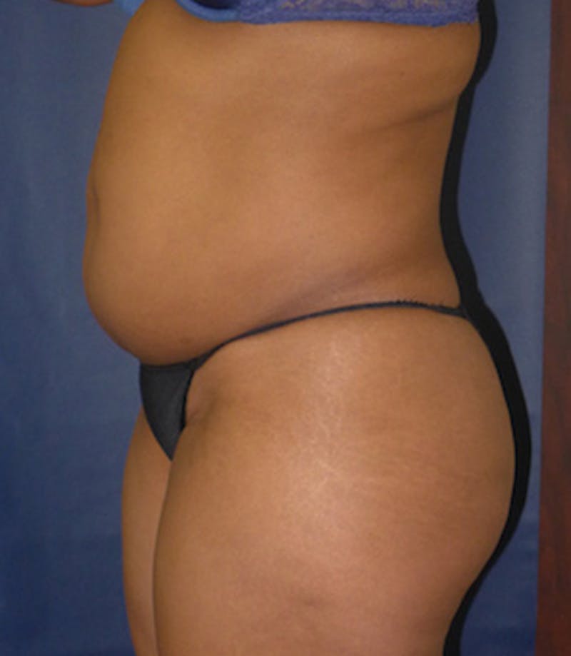 Liposuction Before & After Gallery - Patient 108913 - Image 3