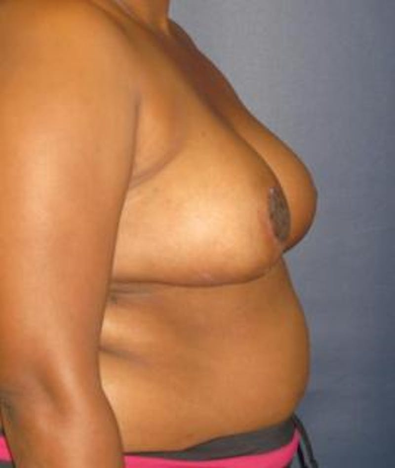 Breast Reduction Before & After Gallery - Patient 596624 - Image 4