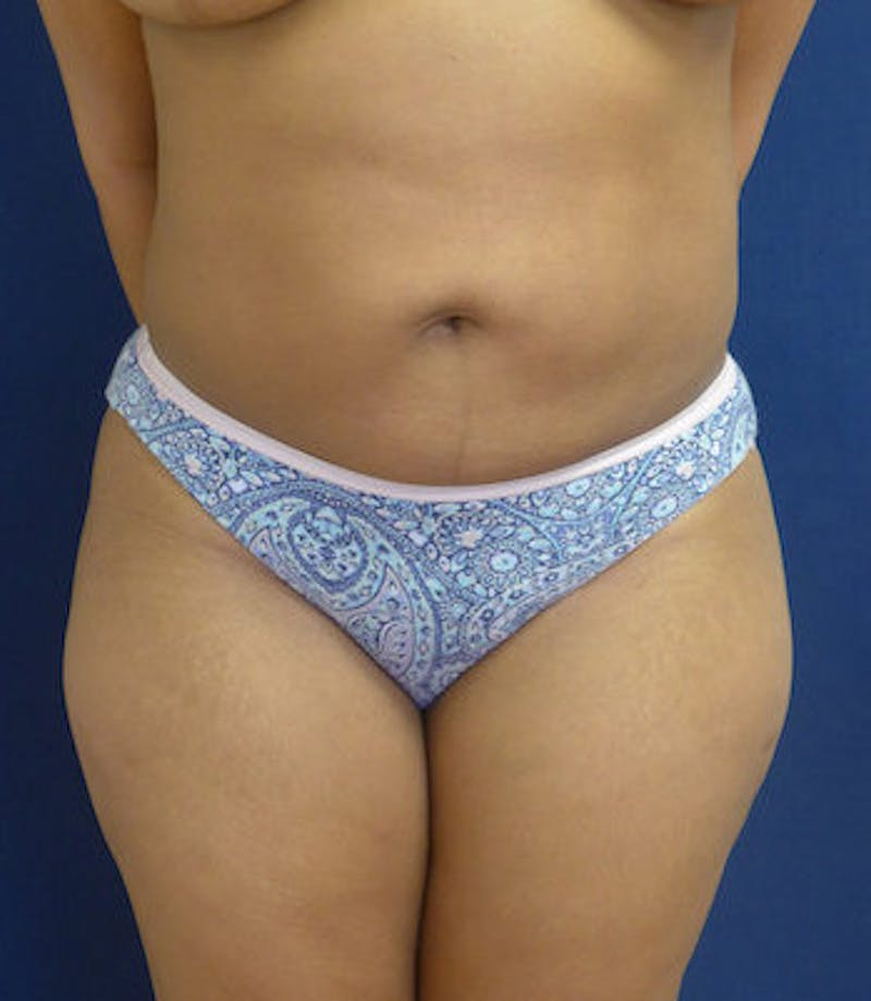 Liposuction Before & After Gallery - Patient 108913 - Image 2