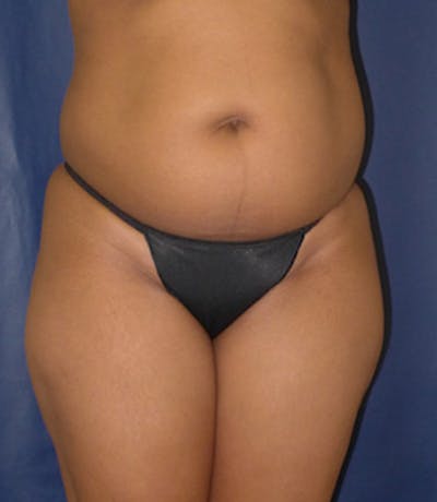 Liposuction Before & After Gallery - Patient 108913 - Image 1