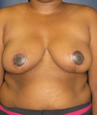 Breast Reduction Before & After Gallery - Patient 596624 - Image 2