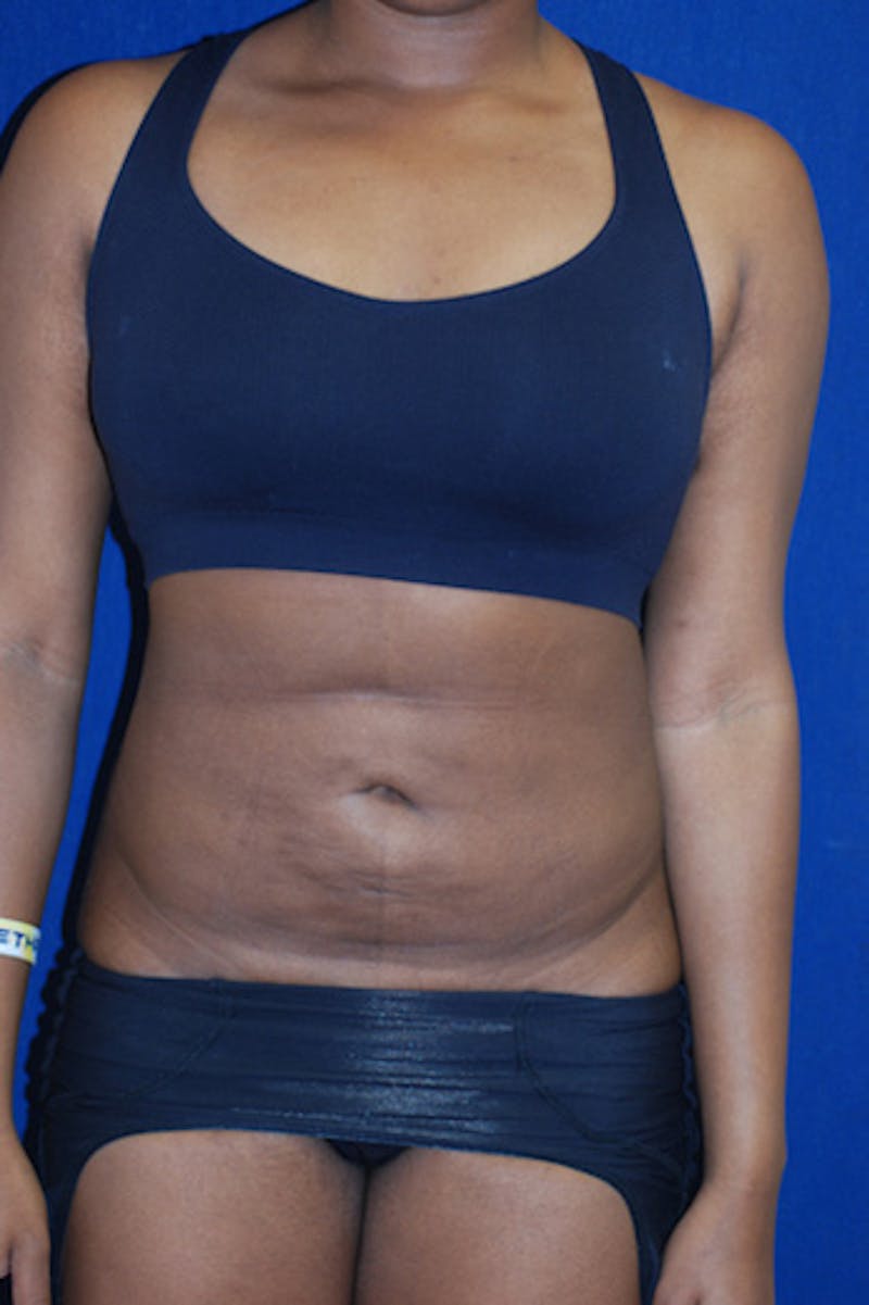 Liposuction Before & After Gallery - Patient 289959 - Image 4