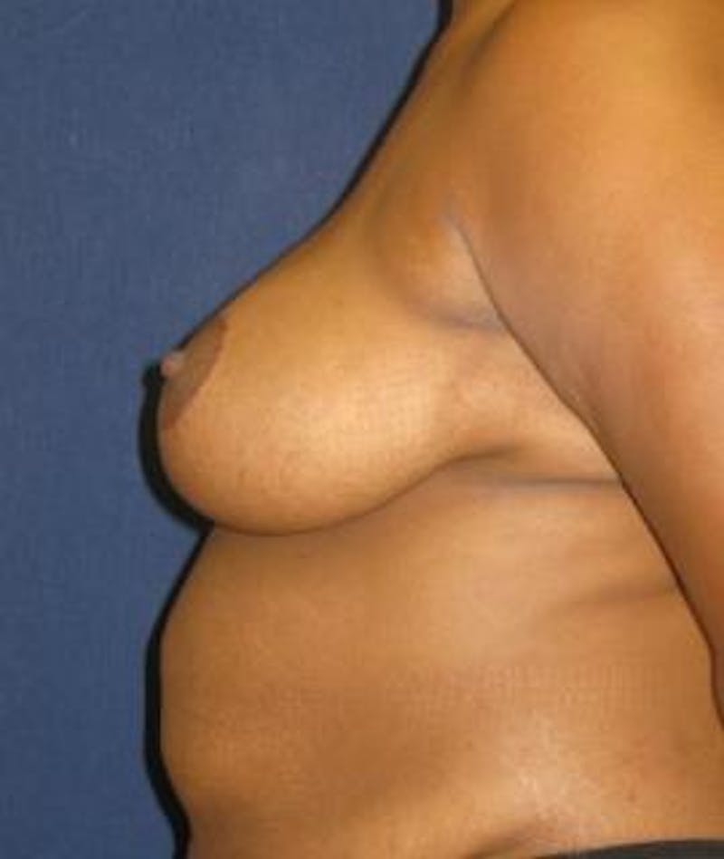 Breast Reduction Before & After Gallery - Patient 345293 - Image 6