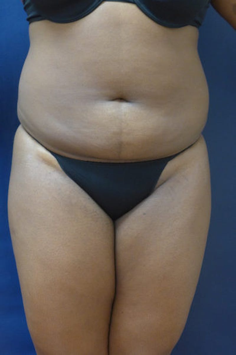 Liposuction Before & After Gallery - Patient 289959 - Image 3
