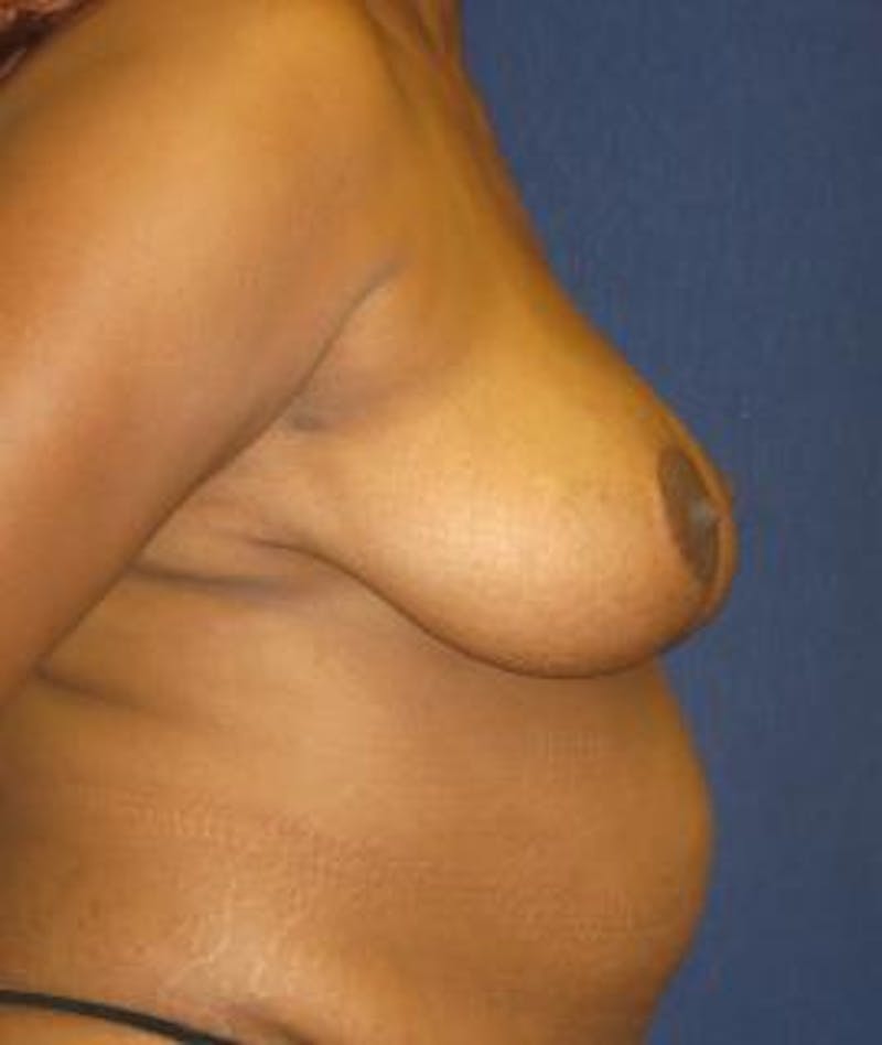 Breast Reduction Before & After Gallery - Patient 345293 - Image 4